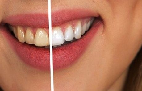 מה ההבדל בין הלבנת שיניים ביתית לבין הלבנת שיניים במרפאת שיניים?